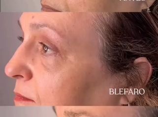 Blefaroplastia - Dra. Mariana Bouvier