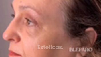 Blefaroplastia - Dra. Mariana Bouvier