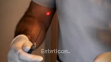 Eliminamos la grasa localizada con Mela - Dr. Rodolfo Villavicencio