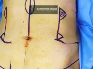 Abdominoplastia - Dr. Fabian Vargas Carrasco