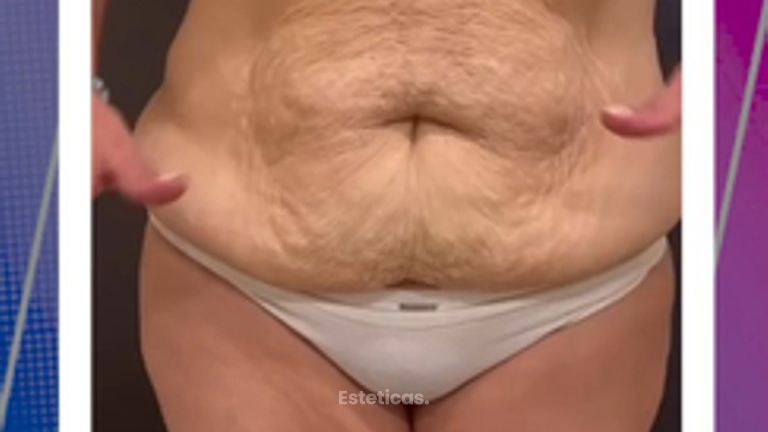 Abdominoplastia - Dr. Emmanuel Manavela Chiapero