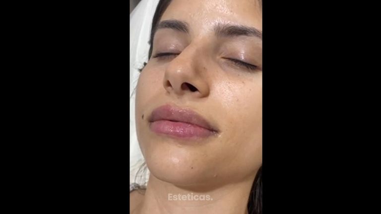 Relleno de labios - Dr. Santiago Rosales Castiglione