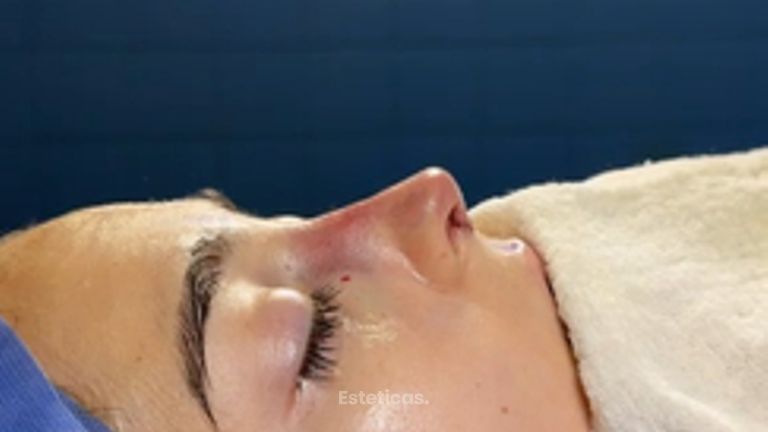 Rinoplastia - Dr. Ignacio Amado