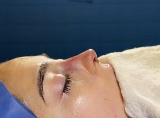 Rinoplastia - Dr. Ignacio Amado