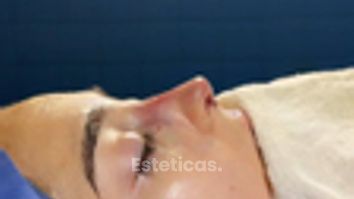 Rinoplastia - Dr. Ignacio Amado