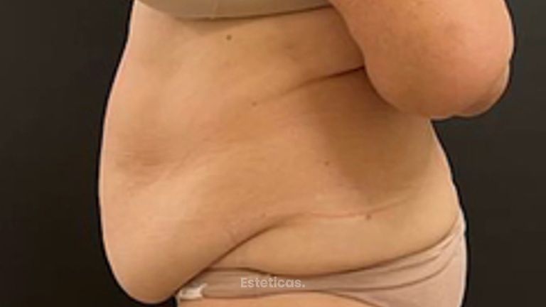 LIPO ABDOMEN Y CINTURA - Dr. Emmanuel Manavela Chiapero