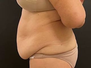 LIPO ABDOMEN Y CINTURA - Dr. Emmanuel Manavela Chiapero
