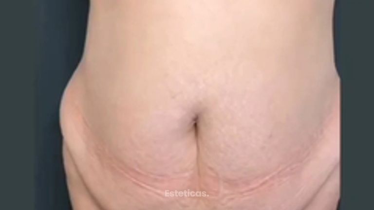 Abdominoplastia + Lipo360 con lipotransferencia glútea - Dra. Mariana Bouvier
