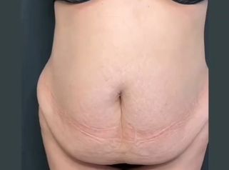 Abdominoplastia + Lipo360 con lipotransferencia glútea - Dra. Mariana Bouvier