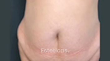 Abdominoplastia + Lipo360 con lipotransferencia glútea - Dra. Mariana Bouvier