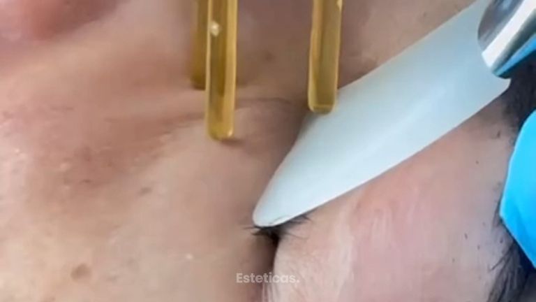 Rejuvencimiento Facial tratamiento NeoGen - Dra. Jimena D. Frasso