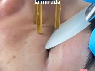 Rejuvencimiento Facial tratamiento NeoGen - Dra. Jimena D. Frasso