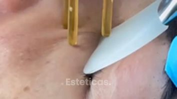 Rejuvencimiento Facial tratamiento NeoGen - Dra. Jimena D. Frasso