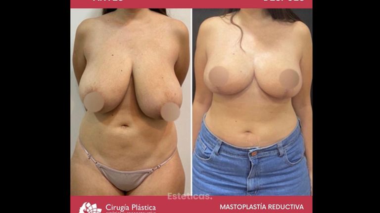 Reducción de mamas - Dr. Emmanuel Manavela Chiapero