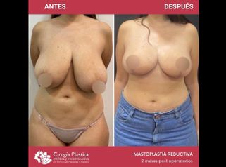 Reducción de mamas - Dr. Emmanuel Manavela Chiapero