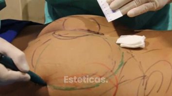 Aumento de gluteos - Dr. Javier Vera Cucchiaro