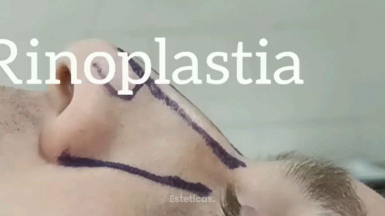Rinoplastía - Dr. David Villagra
