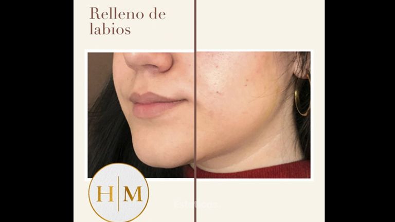 Relleno de labios - Dr. Héctor Martínez Gomez