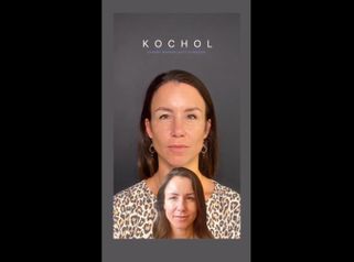 Rinoplastia - Dr. Ariel Kochol