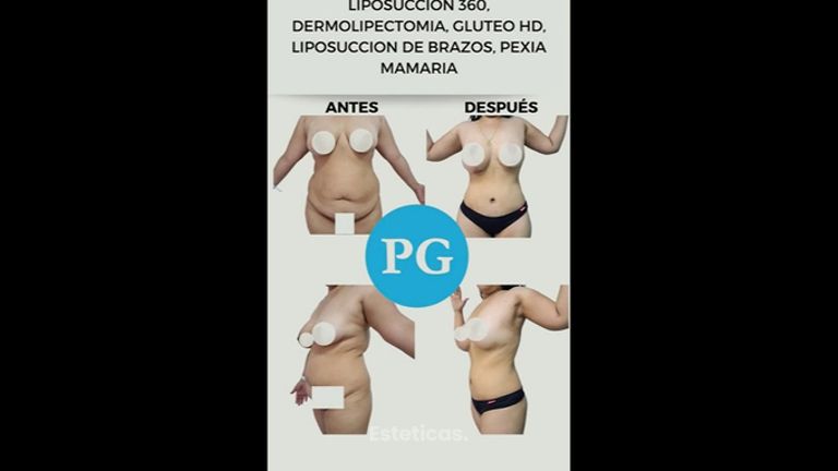 Liposucción - Dra. Paula Granero