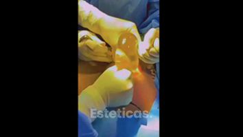 Aumento de mamas - Dr. Javier Nicolía - Centro Médico Palmares