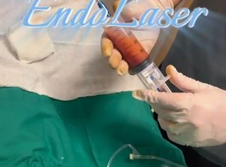 Mela más Endolasér - Dr. Rodolfo Villavicencio
