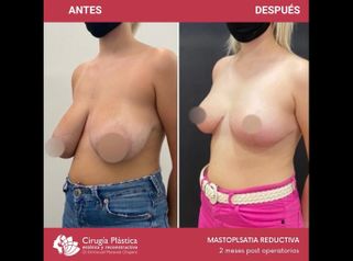 Reducción de mamas - Dr. Emmanuel Manavela Chiapero