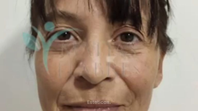 Resultados de un lifting facial - Dr. Matías Llabres