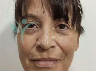 Resultados de un lifting facial - Dr. Matías Llabres