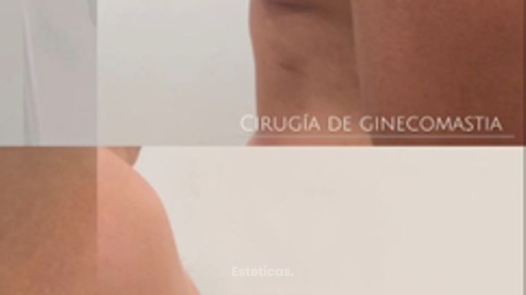 Ginecomastia - Dra. Natalia Solimano
