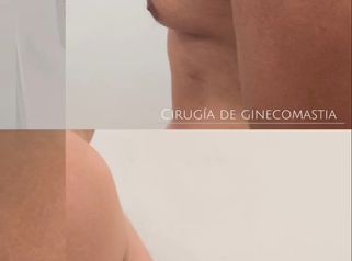 Ginecomastia - Dra. Natalia Solimano
