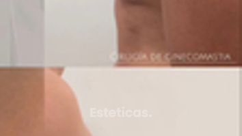 Ginecomastia - Dra. Natalia Solimano