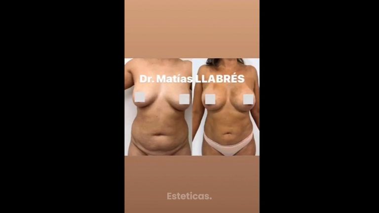 Liposucción - Dr. Matías Llabres