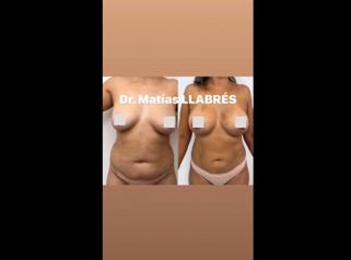 Liposucción - Dr. Matías Llabres