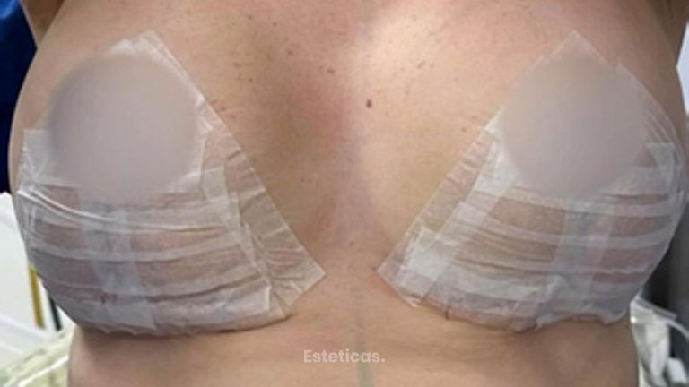 Mastopexia con implantes - Dr. Rodolfo Villavicencio