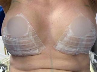 Mastopexia con implantes - Dr. Rodolfo Villavicencio
