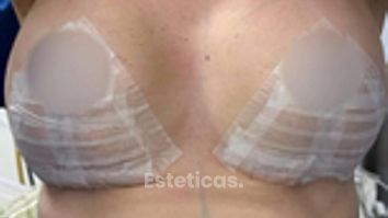 Mastopexia con implantes - Dr. Rodolfo Villavicencio
