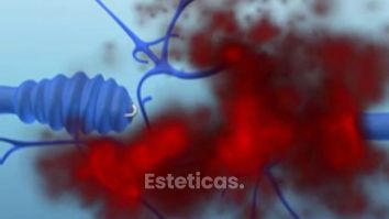 Acaba con tus varices