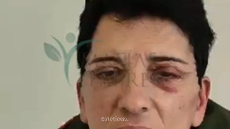 Blefaroplastia - Dr. Matías Llabres