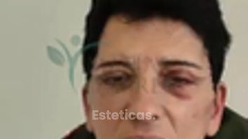 Blefaroplastia - Dr. Matías Llabres