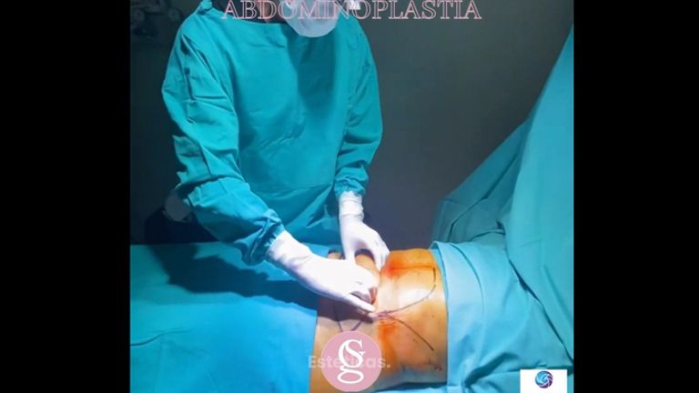 Abdominoplastia - Dr. Sebastián Gallo