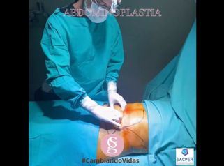 Abdominoplastia - Dr. Sebastián Gallo