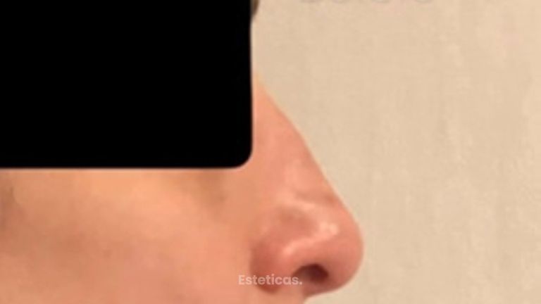 Rinoplastia - Dra. María de la Paz Vélez
