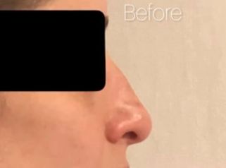 Rinoplastia - Dra. María de la Paz Vélez