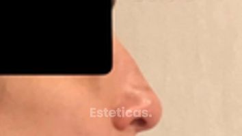 Rinoplastia - Dra. María de la Paz Vélez