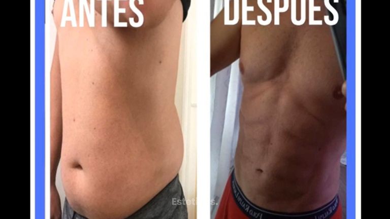 Abdominoplastia