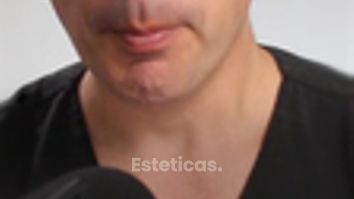 Mastopexia - Dr. Alejandro J Merello Abente