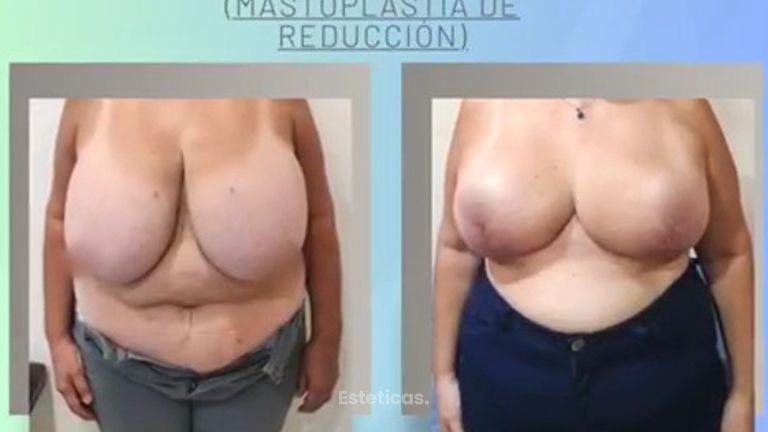 Reducción mamaria - Dr. Juan Ignacio Balestrelli