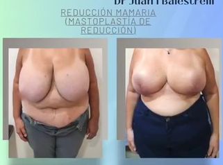 Reducción mamaria - Dr. Juan Ignacio Balestrelli