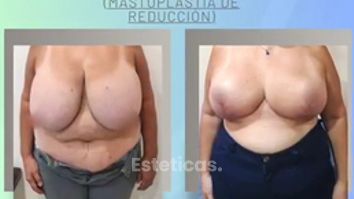 Reducción mamaria - Dr. Juan Ignacio Balestrelli